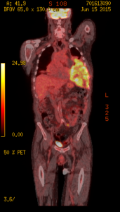 PET Scan for Cancer Los Angeles